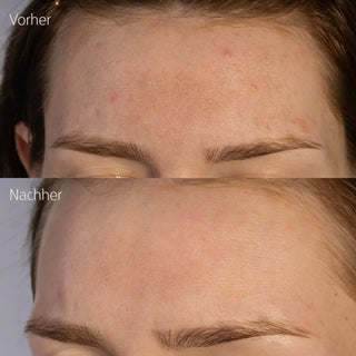 RETINAL-IN SERUM